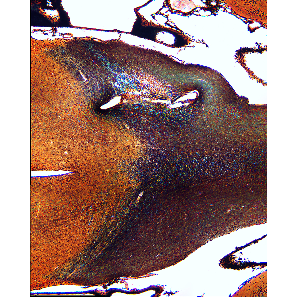 Brain - 59-422 remodeling of optic tract.jpg